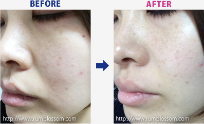 使い続けて1週間目の様子BEFORE AFTER